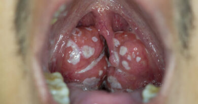 white spots on tonsils